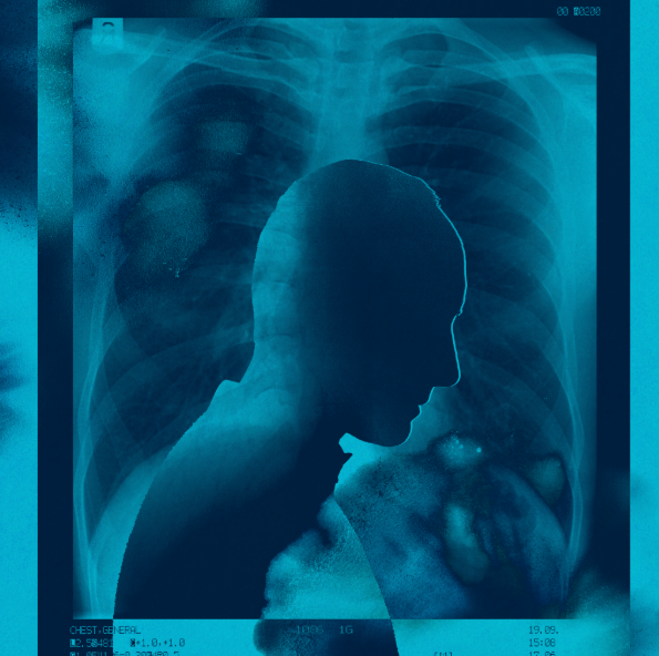 About Half of Patients with Metastatic Lung Cancer Don’t Get Treatment, Study Finds – The New York Times (published May 2026)